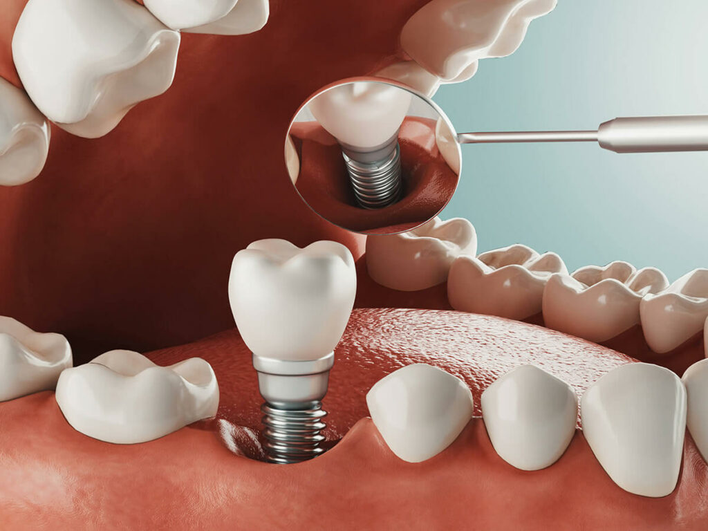 dental implant being placed in mouth