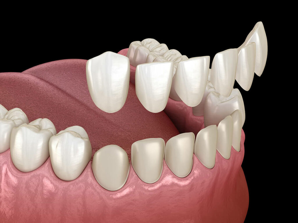 dental veneers being placed on bottom row of teeth