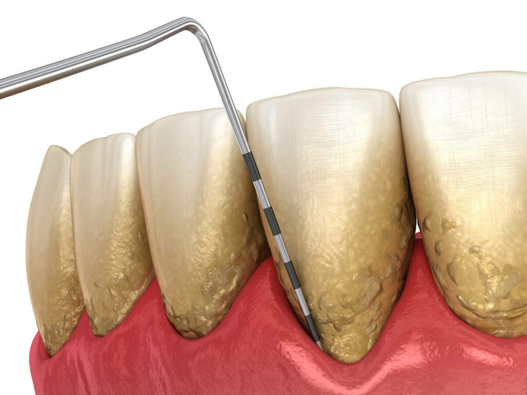 illustration of periodontal disease on teeth