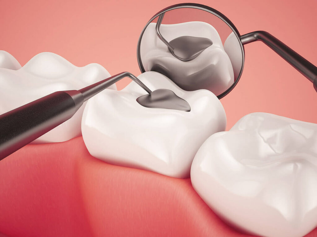 tooth being filled using dental tools