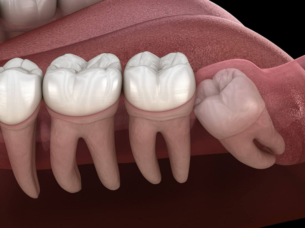 illustration of impacted wisdom tooth