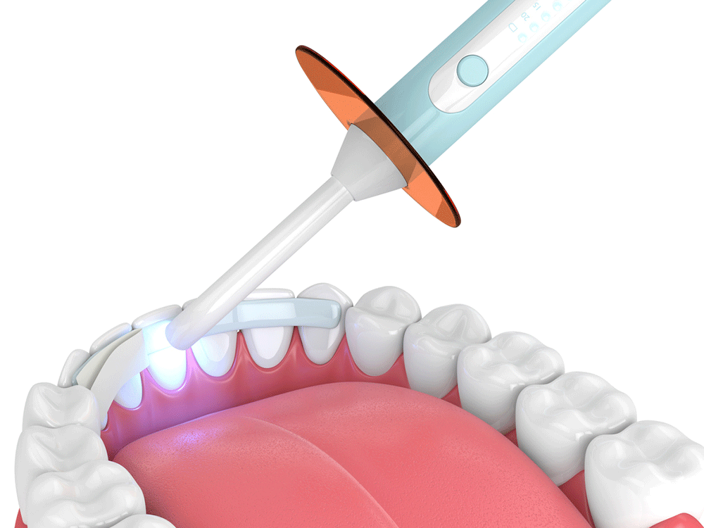 A dental curing light emitting blue light onto a set of teeth held open by a dental retractor.