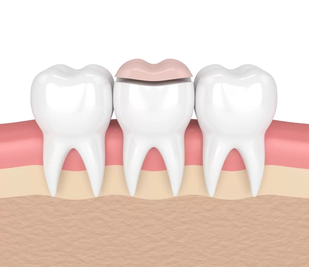 illustration of dental onlay
