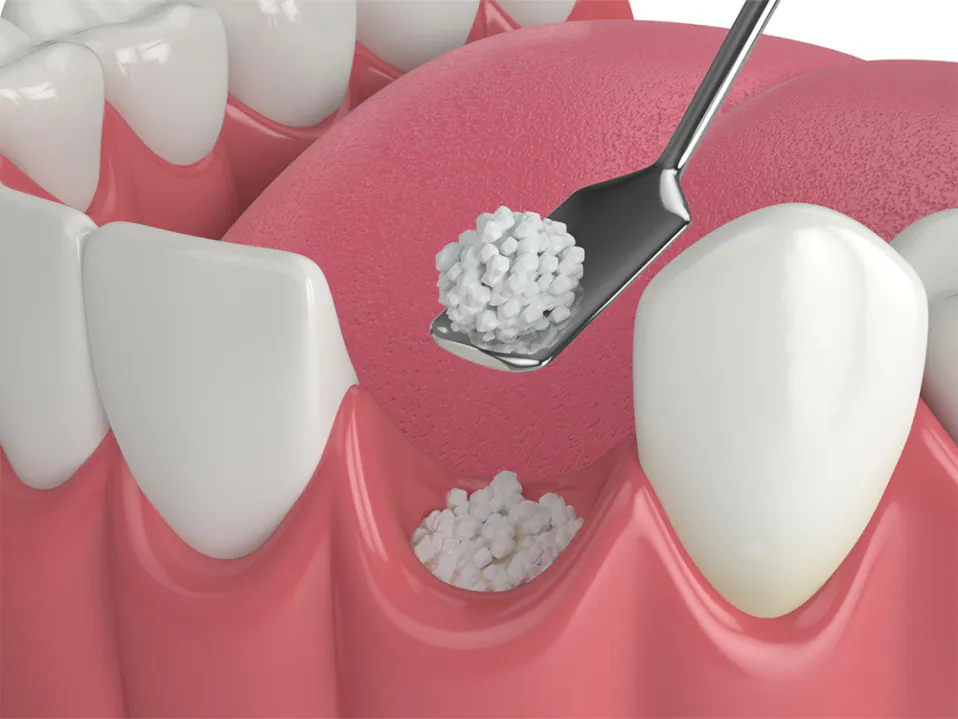 Dental bone grafting and jaw grafting at Palos Heights Dental in Palos Heights, IL