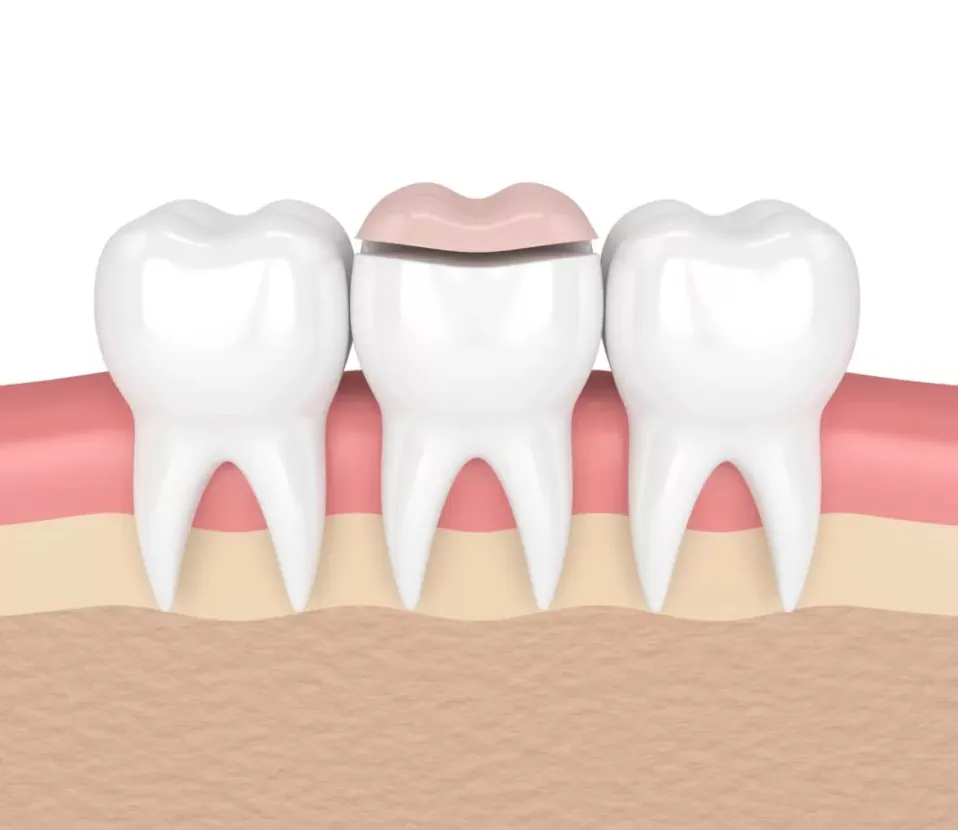 Dental inlays and dental onlays available at Palos Heights Dental in Palos Heights, IL