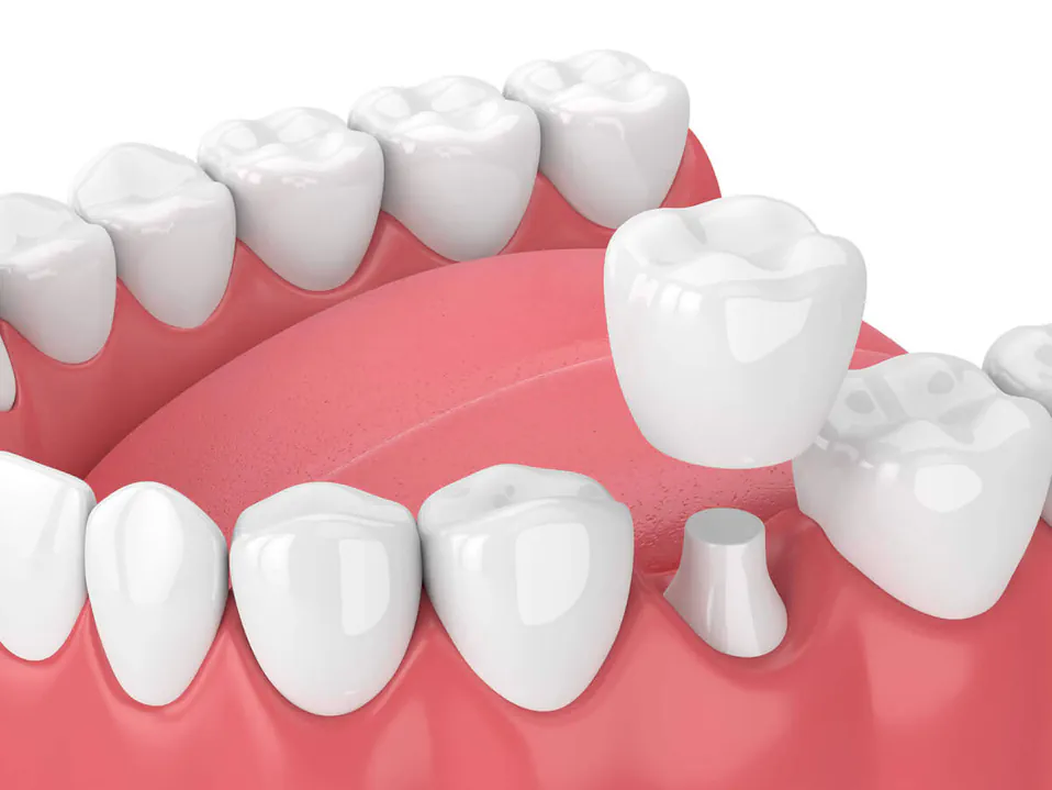 Dental crowns and bridges available at Palos Heights Dental in Palos Heights, IL