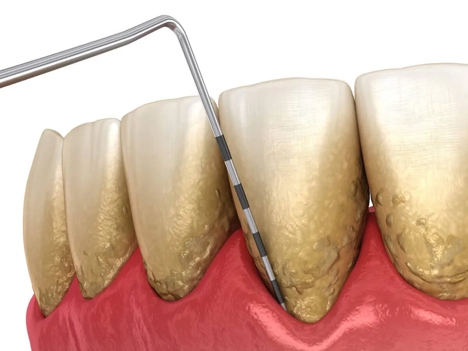 Periodontal and gum disease treatment available at Palos Heights Dental in Palos Heights, IL