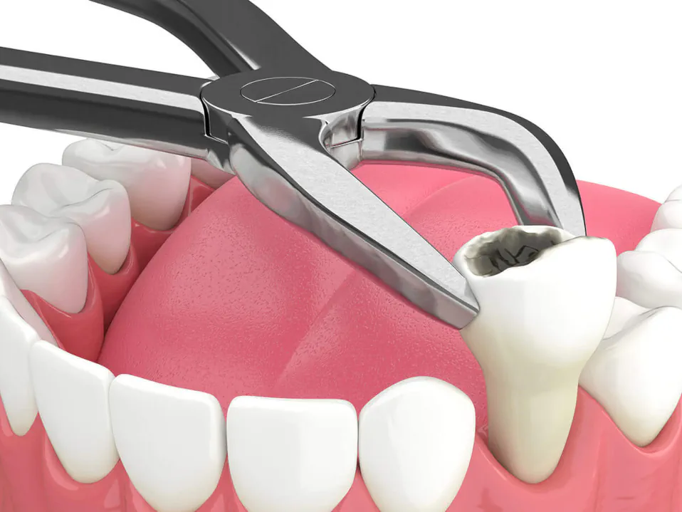 Tooth extraction services available at Palos Heights Dental in Palos Heights, IL