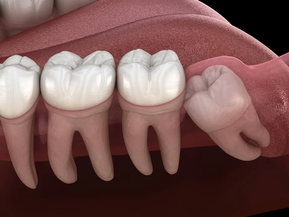 Wisdom teeth removal at Palos Heights Dental in Palos Heights, IL