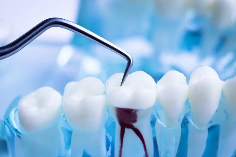 Root Canal Dentistry Service in Palos Heights
